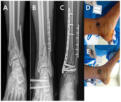 Medicina Free Full Text Treatment Of Soft Tissue Defects After