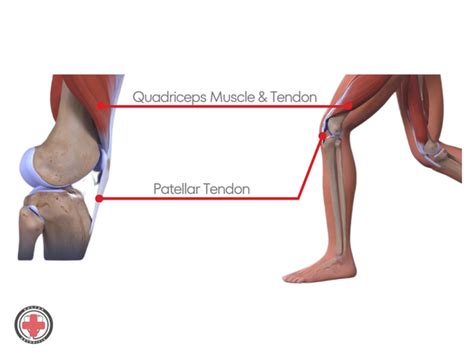 The Best Knee Brace for Quadriceps Tendonitis Relief