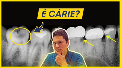 Como Identificar Uma Carie - Como Identificar uma Cárie na Radiografia? - YouTube