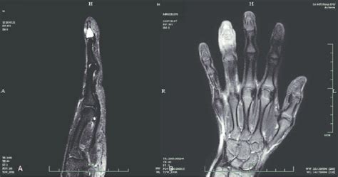 These Images Show Enchondroma In The Distal Phalanx Of The Finger A