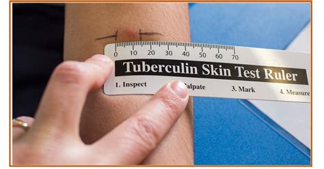 Free Mantoux Tuberculin Skin Testing Ruler