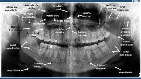 Anatomia Radiográfica Panorâmica - Radiologia Odontológica