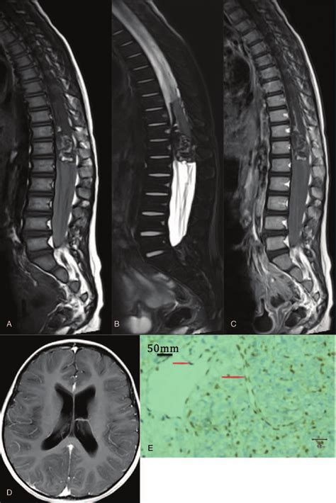 T10 L1 Vertebral At Rt And Supratentorial Cerebral Ventricular System Download Scientific