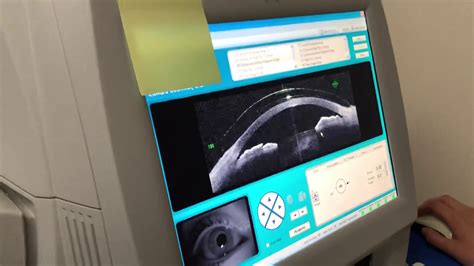 How We Use Optical Coherence Tomography To Evaluate A Scleral Lens Fit