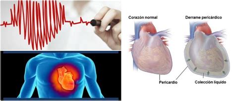 Derrame Pericárdico Causas Síntomas Complicaciones Diagnóstico y