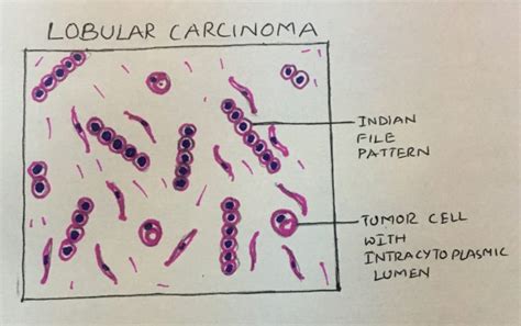 Invasive Lobular carcinoma. – Histopathology.guru