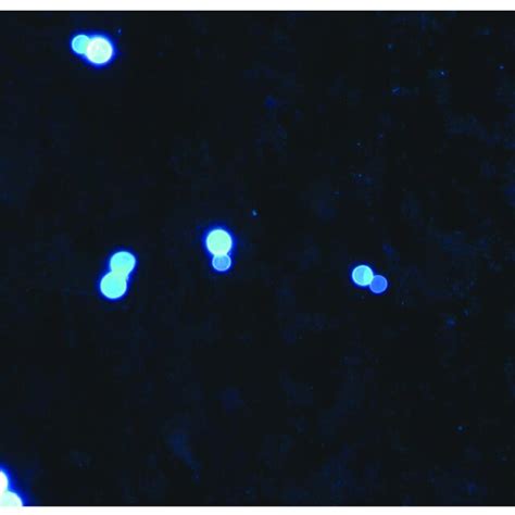 Calcofluor White Stain Of Bronchoalveolar Lavage Fluid From A Patient Download Scientific