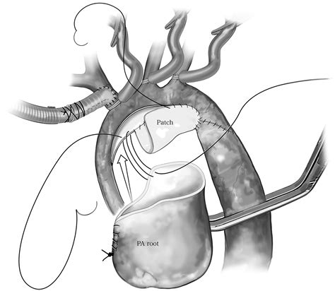 Modified Aortic Arch Reconstruction Combined With Pulmonary Artery