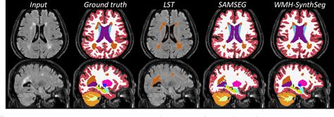 Figure 1 From Quantifying White Matter Hyperintensity And Brain Volumes