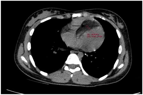 Cardiac Computed Tomography Axial Image Hypodense Lesion Of −90 Hu