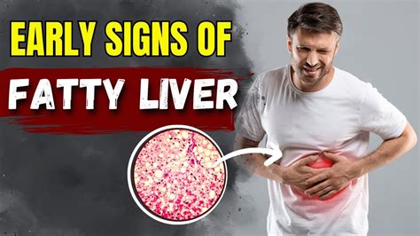 Fatty liver Symptoms | Early Signs Of Fatty Liver Disease – Sky