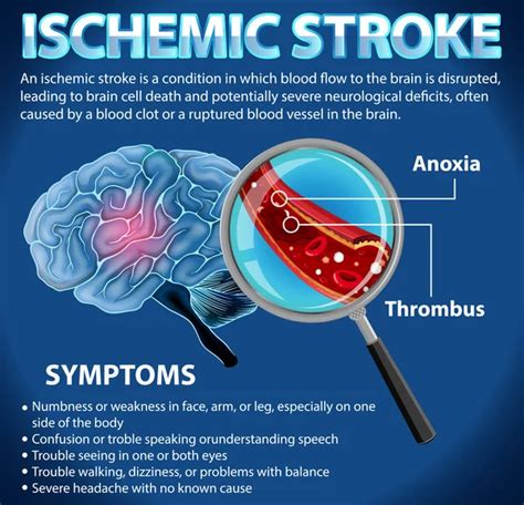 Informative Poster Cerebrovascular Stroke Illustration Stock Vector By ©blueringmedia 650652464