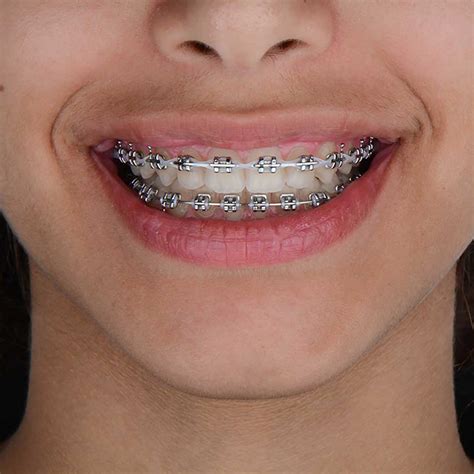 metal ceramic braces  pune jehangir oracare dental centre