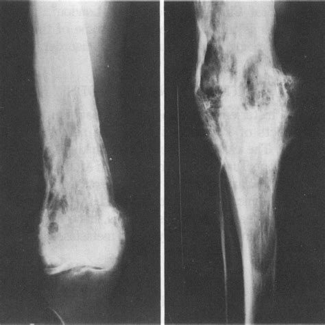 Diaphyseal Paget S Disease A Mainly Lytic Phase Of Paget S