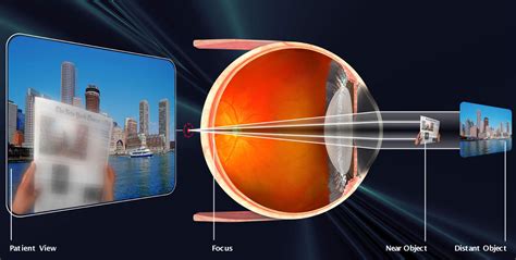 Presbyopia Symptoms And Solutions Innovative Eye Care