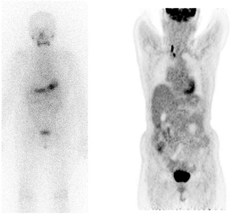 This Patient With Thyroid Cancer Had A Radioiodine Negative Scan Left