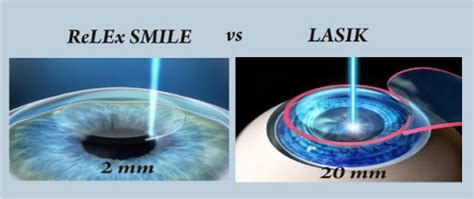 ReLex SMILE Eye Treatment Cost In Delhi ReLex SMILE Eye Treatment Cost