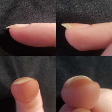 how to fix curved fingernails