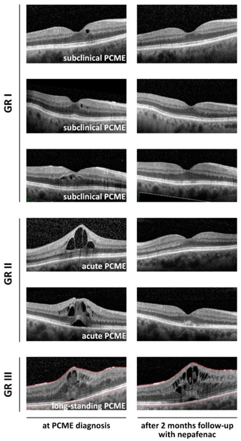 Cystoid Macular Edema Oct