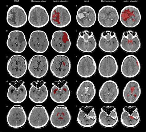 Localization Of The Predicted Lesion On Emergency Brain Ct Images From