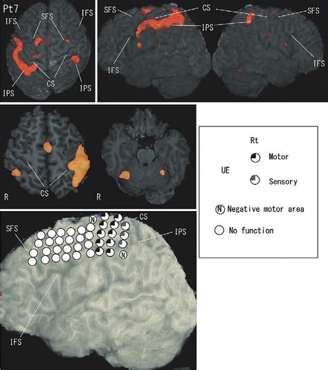 Fmri During A Motor Task And Ecs Mapping In Pt Bold Activation Was