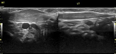 Fibromatosis Colli Image