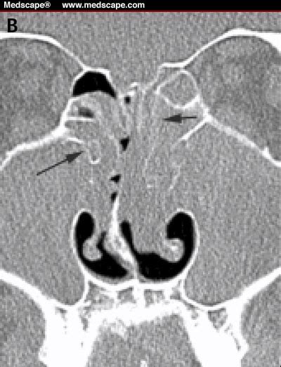 Nasal Polyps Ct Scan Sinuses