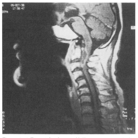 Figure 1 From Acute Epidural Abscess Of The Cervical Spine Caused By