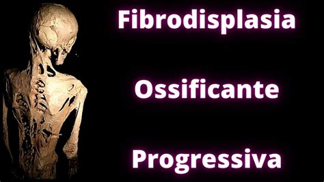 Fibrodisplasia Ossificante Progressiva Fisiologia Humana Youtube