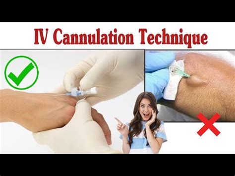 Intravenous Cannulation Technique || IV Cannula Procedure - YouTube