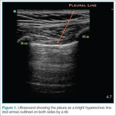 Emergency Ultrasound Pneumothorax Assessment Mdedge Emergency Medicine