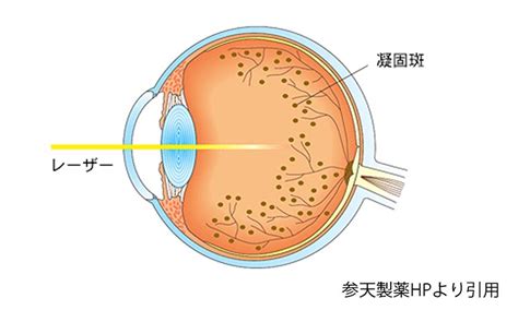 硝子体注射レーザー治療は荻窪駅前眼科へ黄斑浮腫糖尿病黄斑浮腫