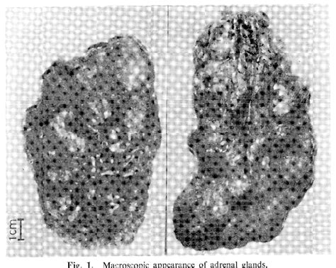 Figure 1 From Giant Macronodular Adrenal Hyperplasia Causing Cushing