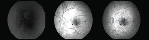 Fluorescein angiography of the left eye at presentation. | Download ...