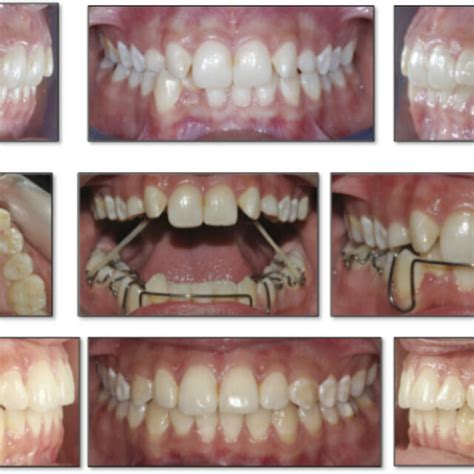 A C Pretreatment Intraoral Images Of A Patient With Bilateral Pdc