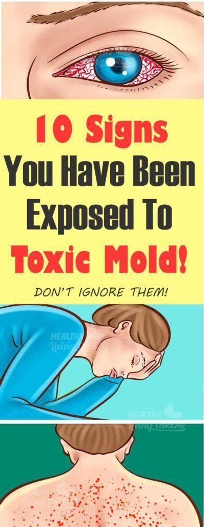 10 Signs You Have Been Exposed To Toxic Mold Toxic Mold Health Mold Exposure