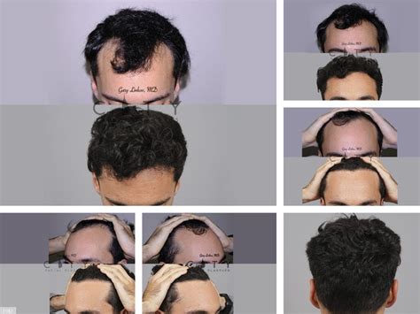 Hair Restoration Nyc Center Hair Transplantation Clinic New York City