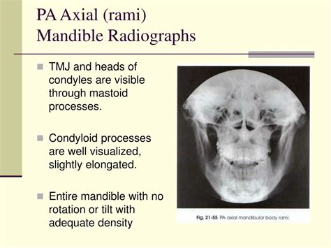 mandible tmj lecture powerpoint
