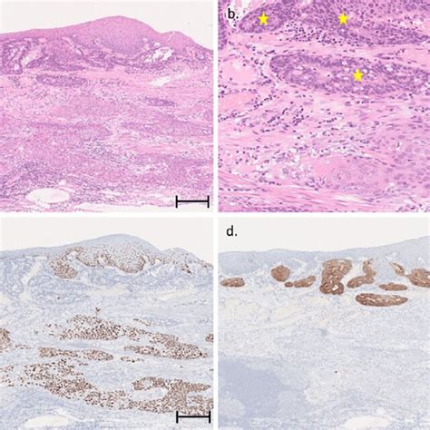 Figure4morphological Transition Between Adenocarcinoma And Scc