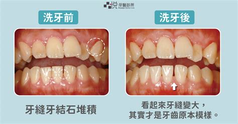 洗牙會痛會流血？多久洗牙一次才能保持牙齒健康？ 新竹品悅牙醫