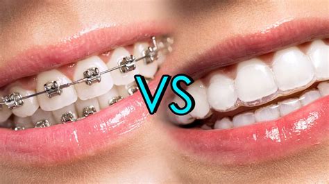 Clear Bracket Braces Vs Metal