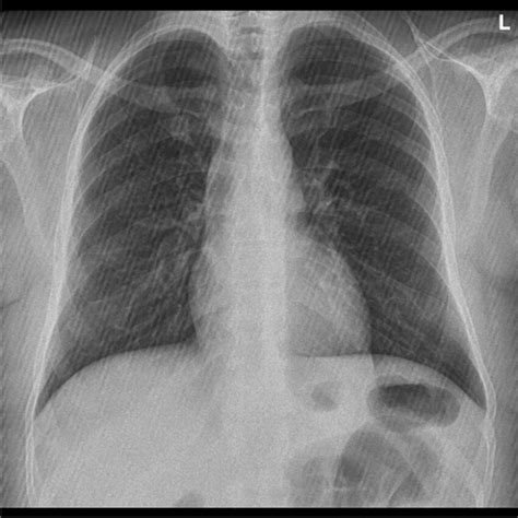 Showing the normal chest x-ray | Download Scientific Diagram