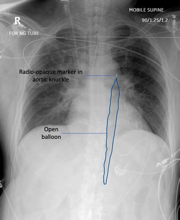 Intra Aortic Balloon Pump Chest X Ray