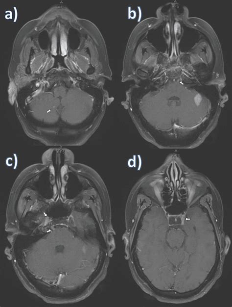 Brain MRI. a) Enhancing cerebellar lesion on the right. b ...