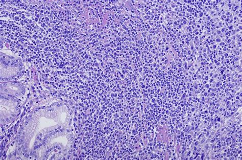 Non Hodgkin Lymphoma Copanlisib Rituximab Combination May Improve