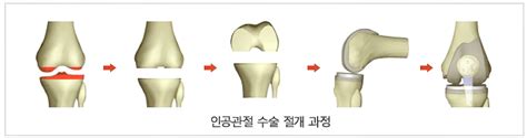 무릎관절 광주21세기병원