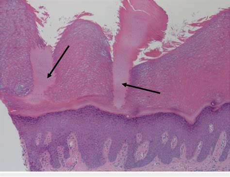 Figure From Spiny Keratoderma Of Nonfamilial Nature And Without