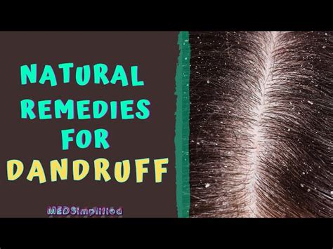 Dandruff Treatment: Home Remedies and Ayurvedic Solutions | SchoolTube