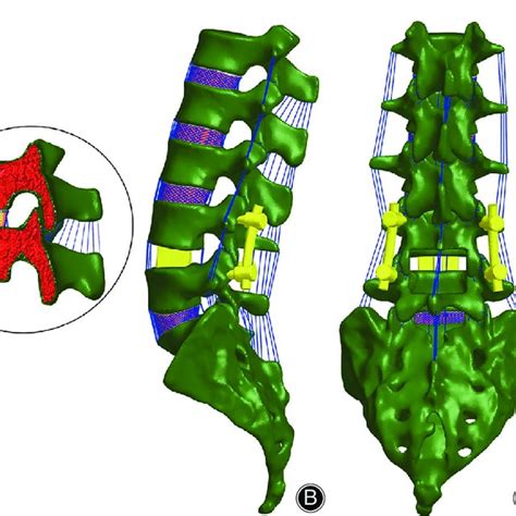 A Lumbosacral Spinal Model With The Posterior Lumbar Interbody Fusion Download Scientific