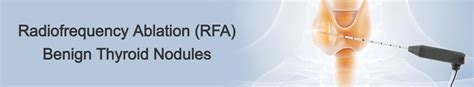 Radiofrequency Ablation Rfa For Benign Thyroid Nodules Miot